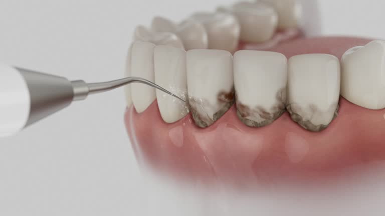 Trusted Wisdom Tooth Removal service in Mountain View, NC - Dentist Open Now